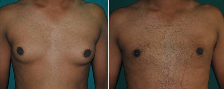 Chest fat liposuction in Kerala